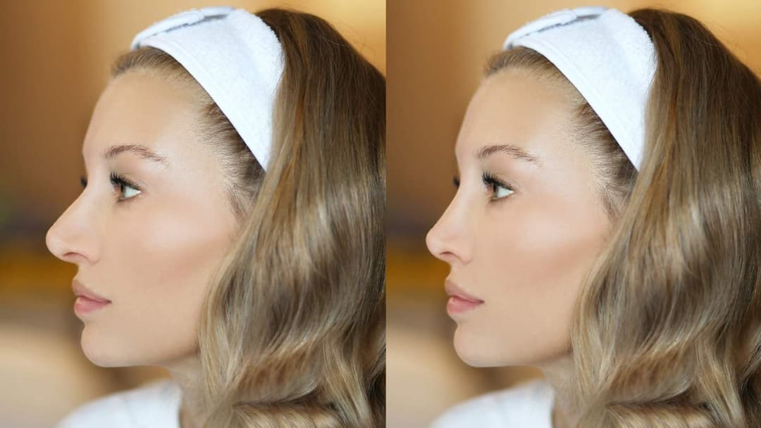 Burun Estetiği - Veneta Clinic Uzman Doktorları